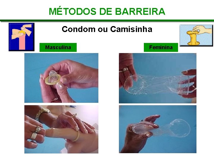 MÉTODOS DE BARREIRA Condom ou Camisinha Masculina Feminina 
