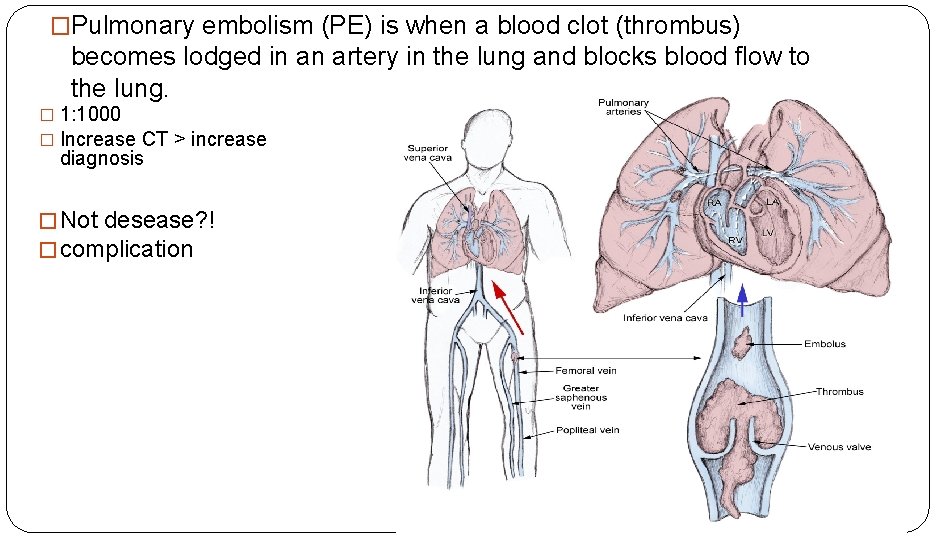 �Pulmonary embolism (PE) is when a blood clot (thrombus) becomes lodged in an artery