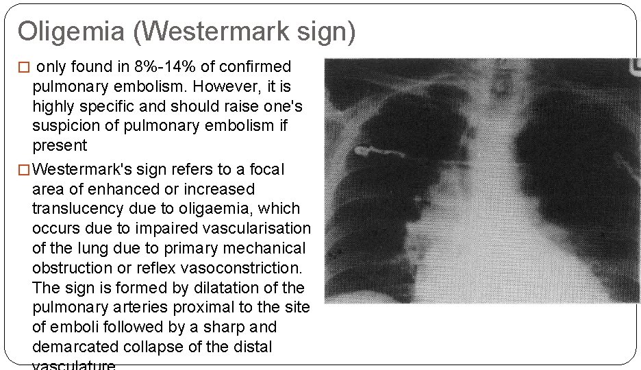 Oligemia (Westermark sign) � only found in 8%-14% of confirmed pulmonary embolism. However, it