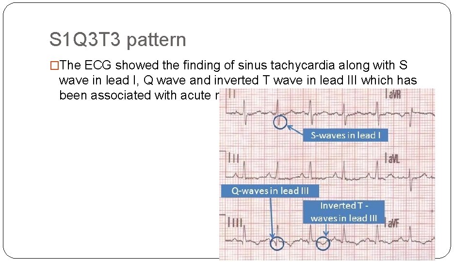 S 1 Q 3 T 3 pattern �The ECG showed the finding of sinus
