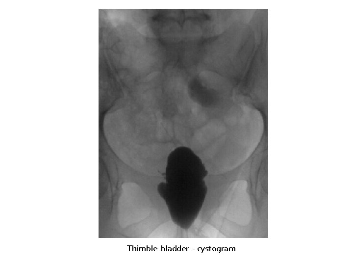 Thimble bladder - cystogram 