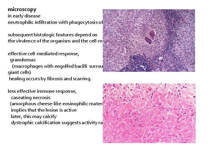 microscopy in early disease neutrophilic infiltration with phagocytosis of the bacilli subsequent histologic features
