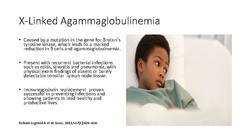 X-Linked Agammaglobulinemia • Caused by a mutation in the gene for Bruton’s tyrosine kinase,