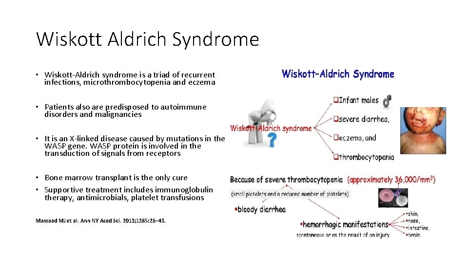 Wiskott Aldrich Syndrome • Wiskott-Aldrich syndrome is a triad of recurrent infections, microthrombocytopenia and