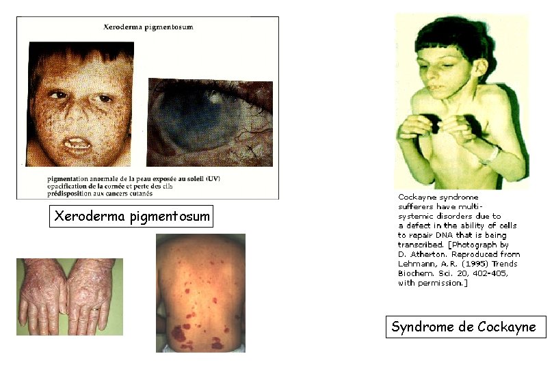 Xeroderma pigmentosum Syndrome de Cockayne 