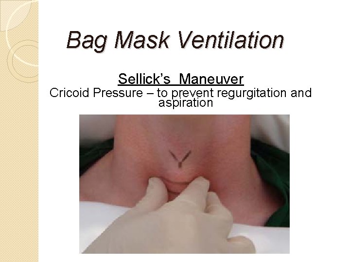 Bag Mask Ventilation Sellick’s Maneuver Cricoid Pressure – to prevent regurgitation and aspiration 