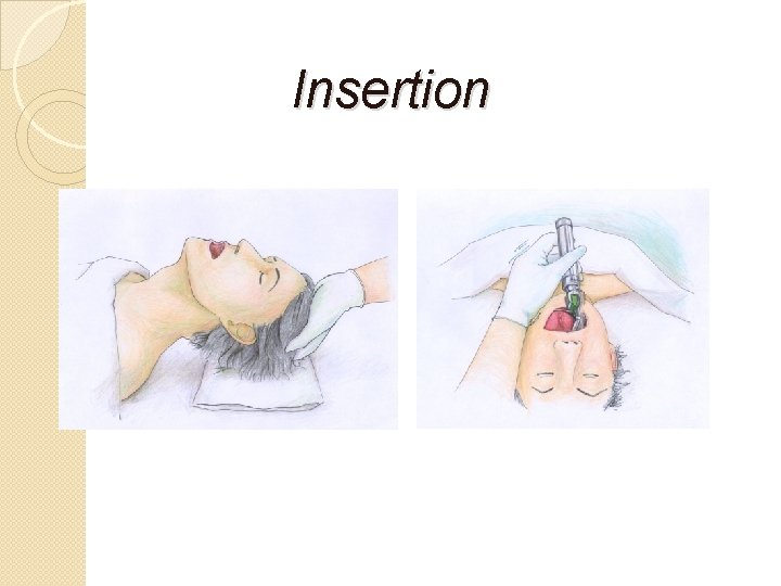 Insertion 