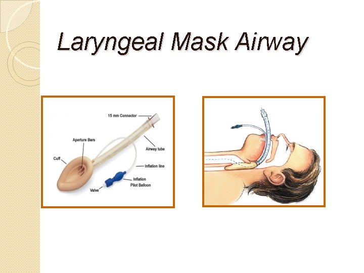 Laryngeal Mask Airway 