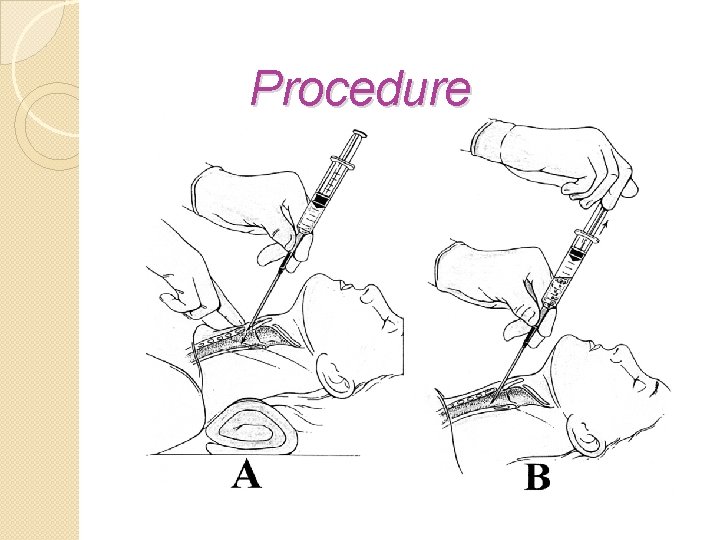 Procedure 