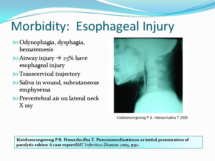 Morbidity: Esophageal Injury Odynophagia, dysphagia, hematemesis Airway injury 25% have esophageal injury Transcervical trajectory