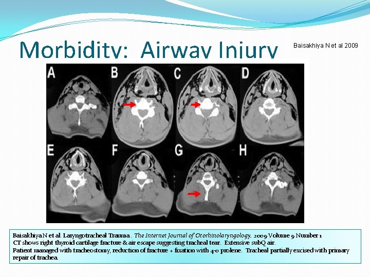 Morbidity: Airway Injury Baisakhiya N et al 2009 Baisakhiya N et al. Laryngotracheal Trauma.