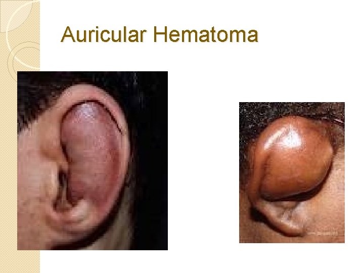 Auricular Hematoma 