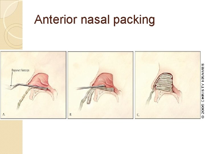 Anterior nasal packing 