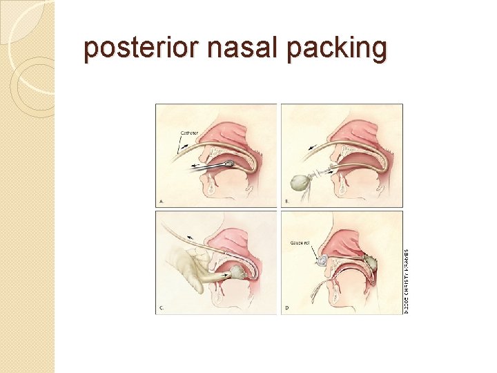 posterior nasal packing 