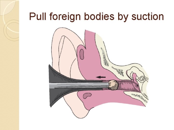 Pull foreign bodies by suction 