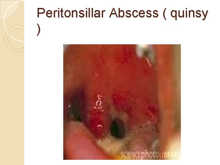 Peritonsillar Abscess ( quinsy ) 