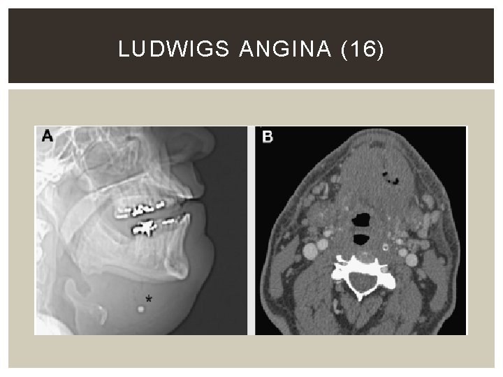 LUDWIGS ANGINA (16) 