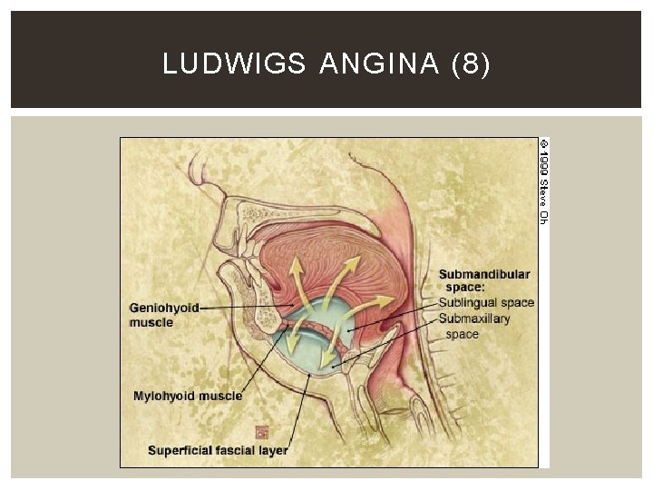 LUDWIGS ANGINA (8) 