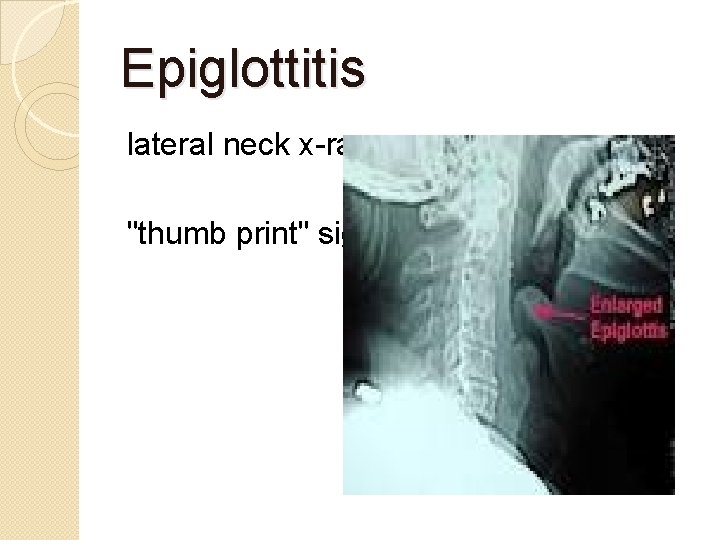 Epiglottitis lateral neck x-ray : "thumb print" sign. 