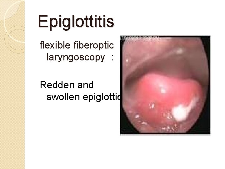 Epiglottitis flexible fiberoptic laryngoscopy : Redden and swollen epiglottic 