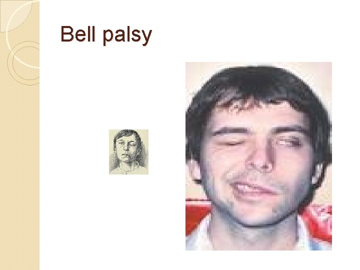 Bell palsy 