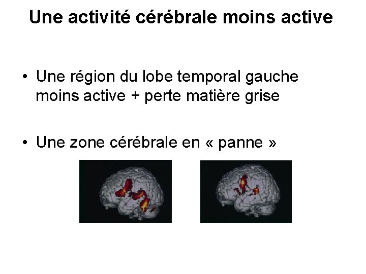  Une activité cérébrale moins active • Une région du lobe temporal gauche moins