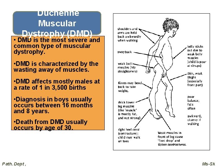Duchenne Muscular Dystrophy (DMD) • DMD is the most severe and common type of Duchenne Muscular Dystrophy (DMD) • DMD is the most severe and common type of