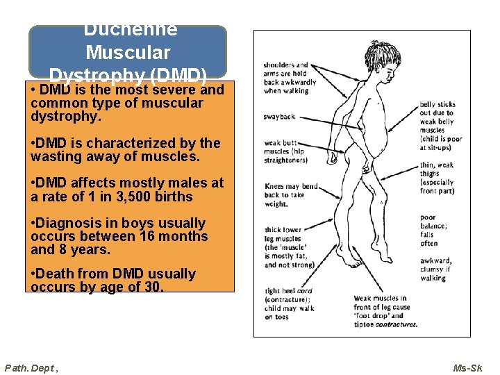 Duchenne Muscular Dystrophy (DMD) • DMD is the most severe and common type of