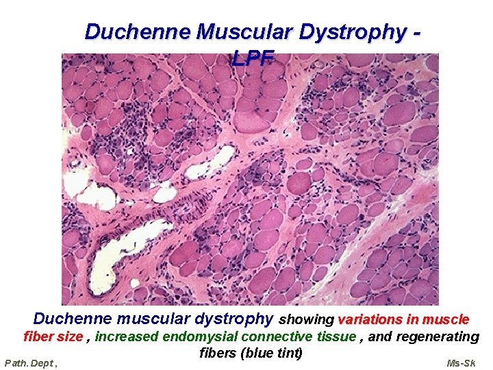 Duchenne Muscular Dystrophy LPF Duchenne muscular dystrophy showing variations in muscle fiber size , Duchenne Muscular Dystrophy LPF Duchenne muscular dystrophy showing variations in muscle fiber size ,