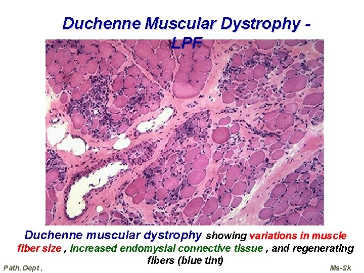 Duchenne Muscular Dystrophy LPF Duchenne muscular dystrophy showing variations in muscle fiber size ,