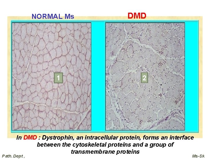 NORMAL Ms 1 DMD 2 In DMD : Dystrophin, an intracellular protein, forms an