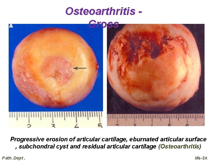 Osteoarthritis Gross Progressive erosion of articular cartilage, eburnated articular surface , subchondral cyst and