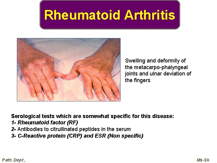Rheumatoid Arthritis Swelling and deformity of the metacarpo-phalyngeal joints and ulnar deviation of the