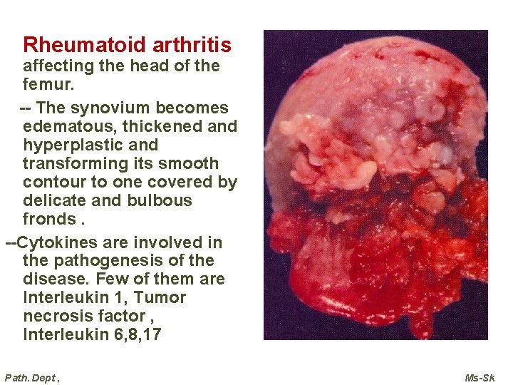 Rheumatoid arthritis affecting the head of the femur. -- The synovium becomes edematous, thickened