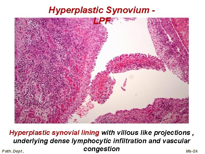 Hyperplastic Synovium LPF Hyperplastic synovial lining with villous like projections , underlying dense lymphocytic Hyperplastic Synovium LPF Hyperplastic synovial lining with villous like projections , underlying dense lymphocytic