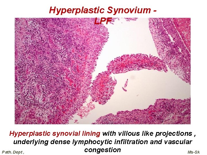 Hyperplastic Synovium LPF Hyperplastic synovial lining with villous like projections , underlying dense lymphocytic