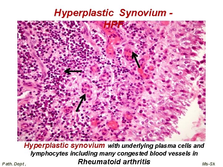 Hyperplastic Synovium HPF Hyperplastic synovium with underlying plasma cells and lymphocytes including many congested Hyperplastic Synovium HPF Hyperplastic synovium with underlying plasma cells and lymphocytes including many congested