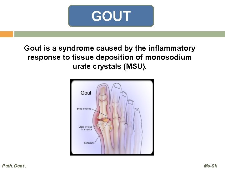 GOUT Gout is a syndrome caused by the inflammatory response to tissue deposition of GOUT Gout is a syndrome caused by the inflammatory response to tissue deposition of