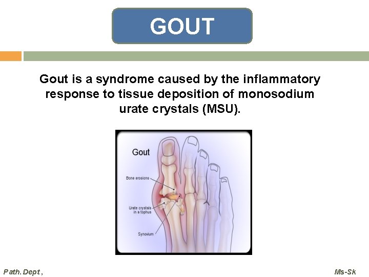 GOUT Gout is a syndrome caused by the inflammatory response to tissue deposition of