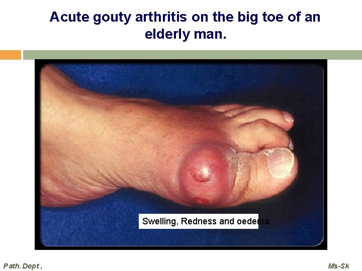 Acute gouty arthritis on the big toe of an elderly man. Swelling, Redness and