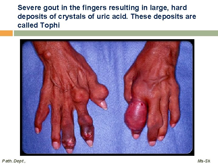 Severe gout in the fingers resulting in large, hard deposits of crystals of uric