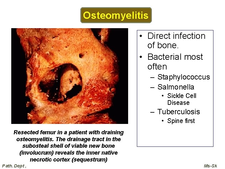 Osteomyelitis • Direct infection of bone. • Bacterial most often – Staphylococcus – Salmonella Osteomyelitis • Direct infection of bone. • Bacterial most often – Staphylococcus – Salmonella