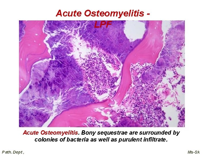 Acute Osteomyelitis LPF Acute Osteomyelitis. Bony sequestrae are surrounded by colonies of bacteria as