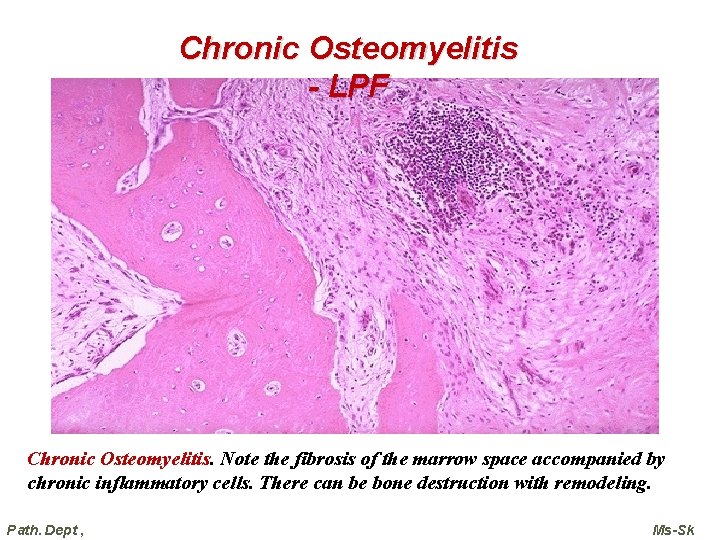 Chronic Osteomyelitis - LPF Chronic Osteomyelitis. Note the fibrosis of the marrow space accompanied Chronic Osteomyelitis - LPF Chronic Osteomyelitis. Note the fibrosis of the marrow space accompanied