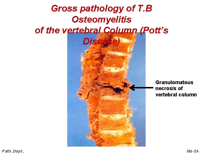 Gross pathology of T. B Osteomyelitis of the vertebral Column (Pott’s Disease) Granulomatous necrosis Gross pathology of T. B Osteomyelitis of the vertebral Column (Pott’s Disease) Granulomatous necrosis