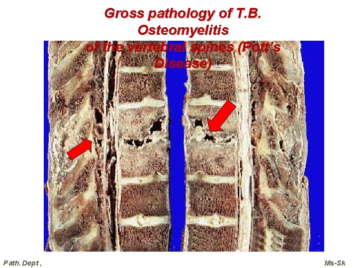 Gross pathology of T. B. Osteomyelitis of the vertebral spines (Pott’s Disease) Path. Dept