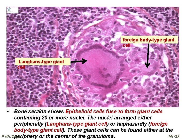 foreign body-type giant cell Langhans-type giant cell • Bone section shows Epithelioid cells fuse