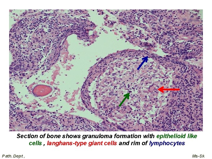 Section of bone shows granuloma formation with epithelioid like cells , langhans-type giant cells Section of bone shows granuloma formation with epithelioid like cells , langhans-type giant cells
