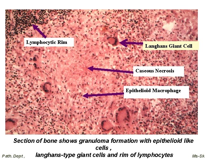 Lymphocytic Rim Langhans Giant Cell Caseous Necrosis Epithelioid Macrophage Section of bone shows granuloma Lymphocytic Rim Langhans Giant Cell Caseous Necrosis Epithelioid Macrophage Section of bone shows granuloma