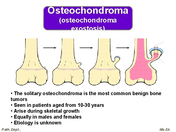 Osteochondroma (osteochondroma exostosis) • The solitary osteochondroma is the most common benign bone tumors